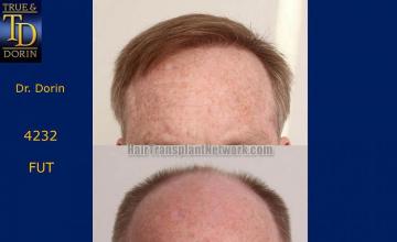 Before and after hair restoration procedure images