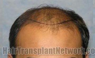 Hair replacement surgery before and after images