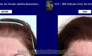 Hair restoration procedure before and after results