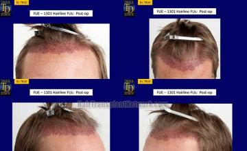 Hair transplantation surgery before and after pictures
