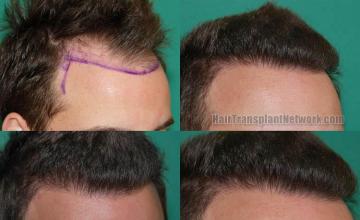 Hair restoration procedure before and after results