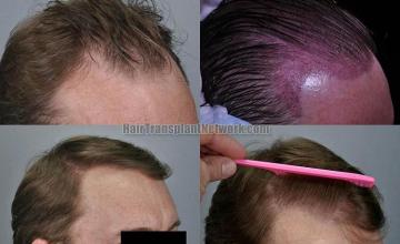 Hair transplantation surgery before and after pictures