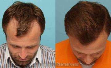 Hair transplantation surgery before and after photos