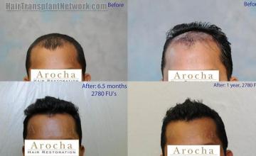 Hair restoration procedure before and after results