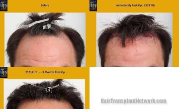 Hair restoration procedure before and after results