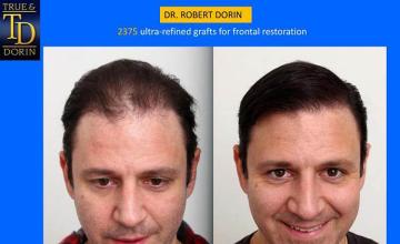 Hair restoration procedure before and after results