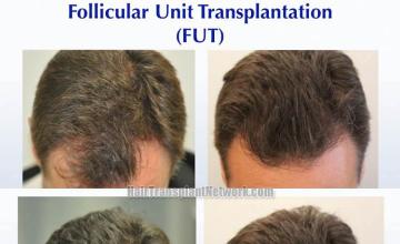 Hair transplantation surgery before and after photos