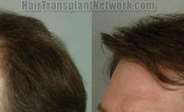 Hair transplantation surgery before and after photos