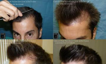 Hair transplantation surgery before and after photos