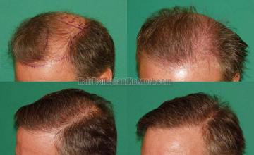 Hair restoration surgical procedure before and after pictures