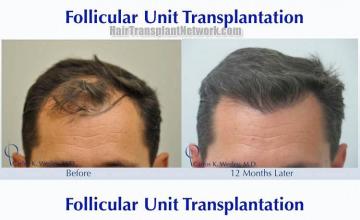 Hair transplantation surgery before and after photos