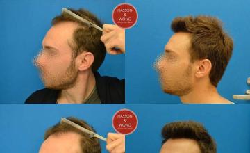 Hair transplantation surgery before and after photos