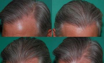 Right - Left side images of postoperative hair restoration procedure