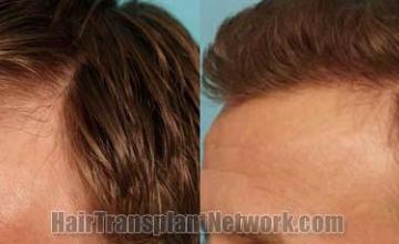 Hair transplantation surgery before and after pictures