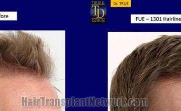 Hair transplantation surgery before and after photos