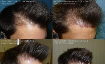 Hair restoration procedure before and after results