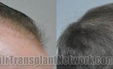 Hair restoration procedure before and after results