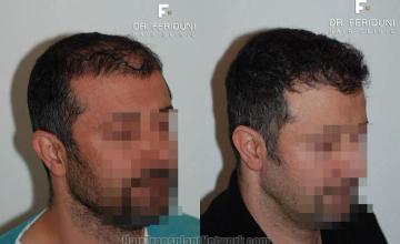 Hair transplantation surgery before and after images