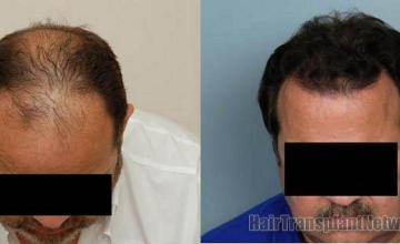 Top View - Hair restoration result photos