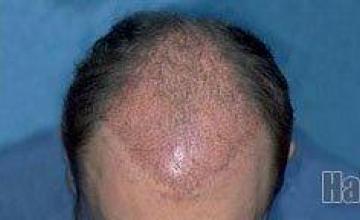 Hair restoration repair procedure before and after photos