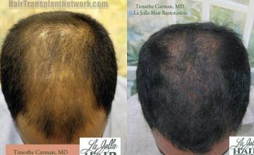 Hair transplantation surgery before and after photos