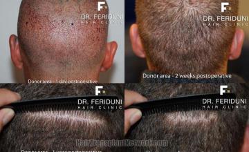 Hair transplantation surgery before and after images