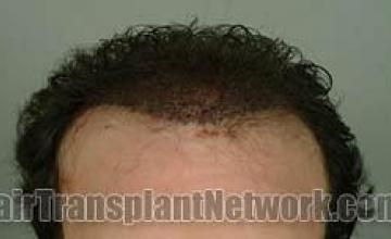 Front view before and after hair restoration procedure