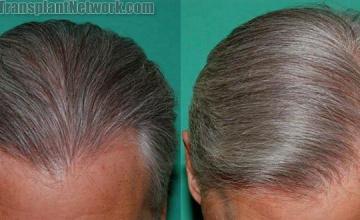 Front view photos showing postoperative hair transplant results