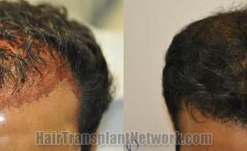 Hair restoration procedure before and after results