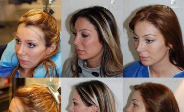 Left side photos of woman's hair restoration