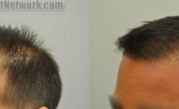 Left view before and after hair transplant procedure