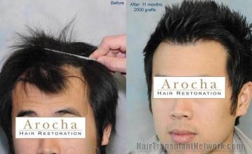 Before and after surgical hair restoration images