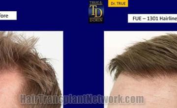 Hair transplantation surgery before and after images