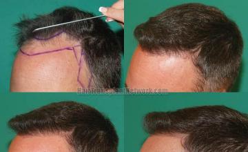 Hair transplantation surgery before and after photos