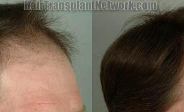 Hair restoration procedure before and after results