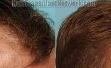 Hair transplantation surgery before and after images