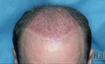 Hair transplant repair session with 1825 grafts