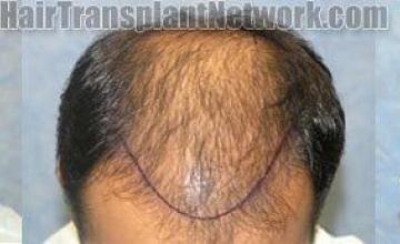  before and after pictures