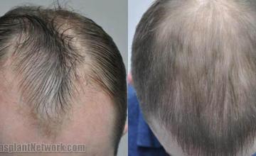 Before and after hair transplantation result photographs