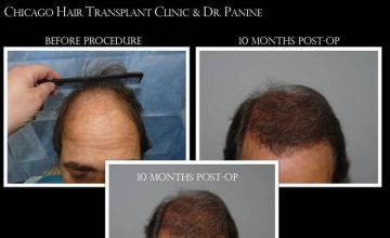 Hair restoration procedure before and after results