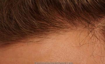 Hair restoration procedure before and after pictures