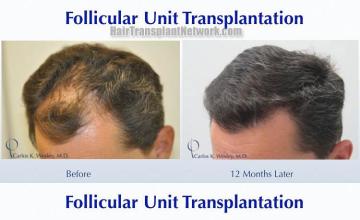 Hair restoration procedure before and after pictures