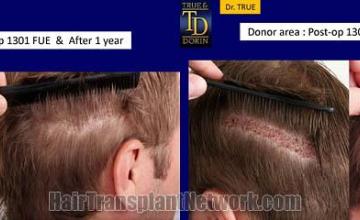 Hair restoration procedure before and after pictures