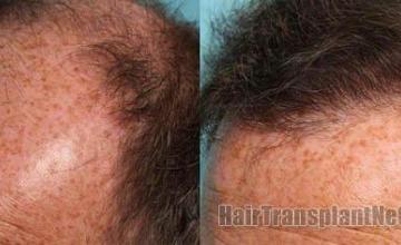 Images of before and after hair replacement procedure