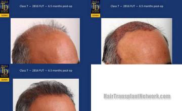 Hair transplantation surgery before and after photos