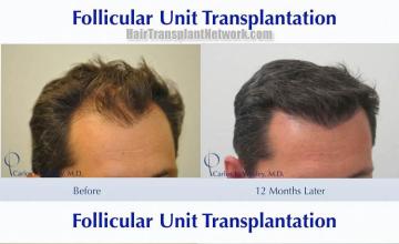 Hair transplantation surgery before and after pictures