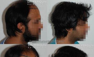 Hair transplantation surgery before and after photos