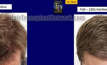 Hair restoration procedure before and after results