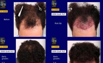 Hair restoration procedure before and after results