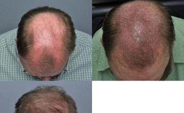 Hair transplantation surgery before and after photos